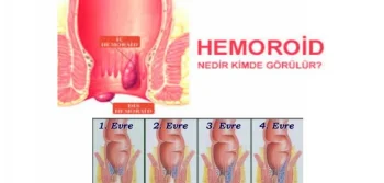 Hemoroit Nedir Nasıl Tedavi Edilir?